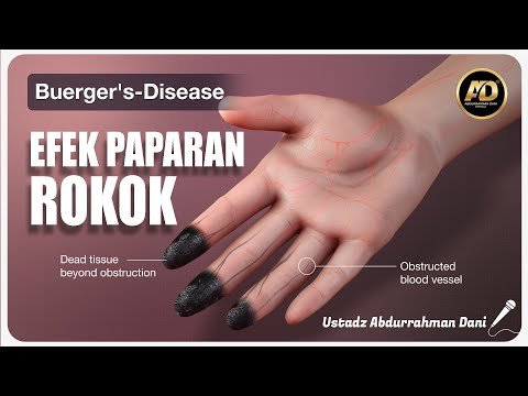efek paparan rokok, bueger's disease